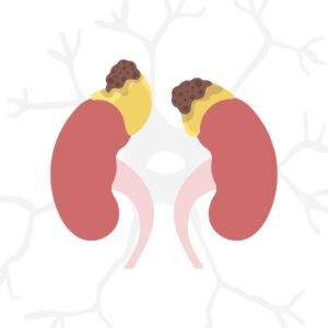 Adrenal disorders