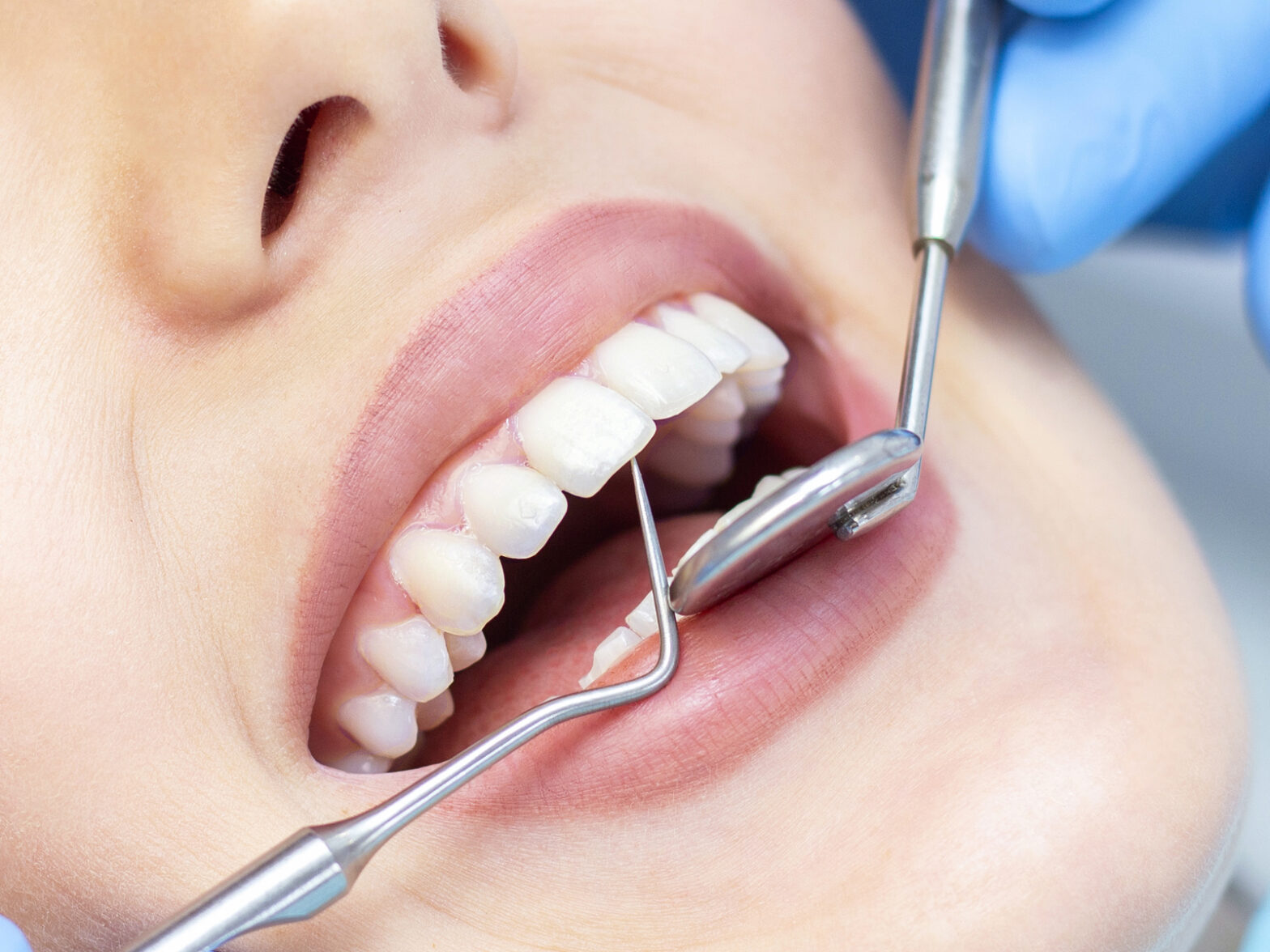 Dental-Cleaning
