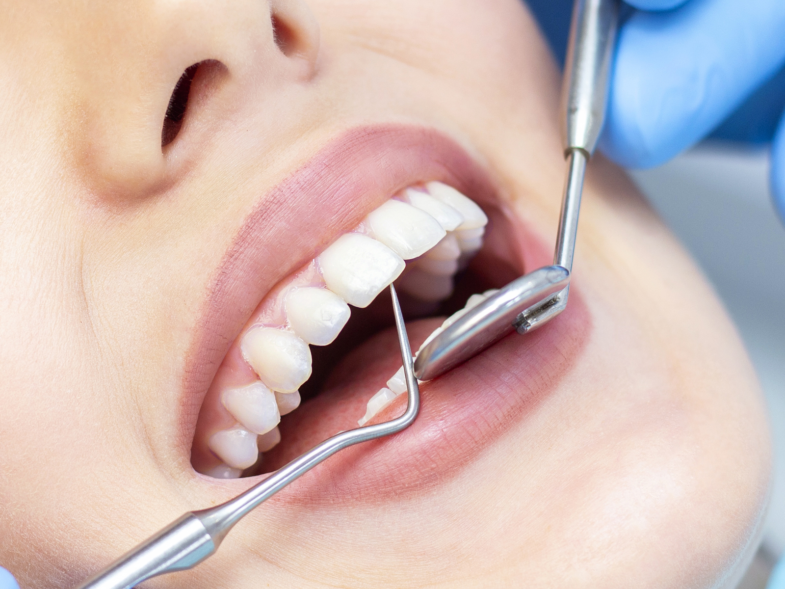 Dental-Cleaning
